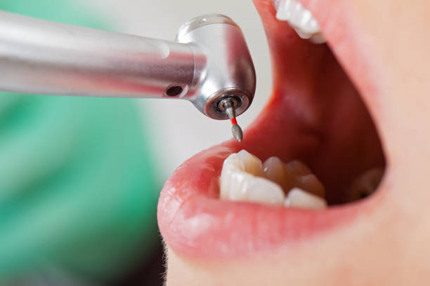 Best Emergency Tooth Extraction in Aurora, MN